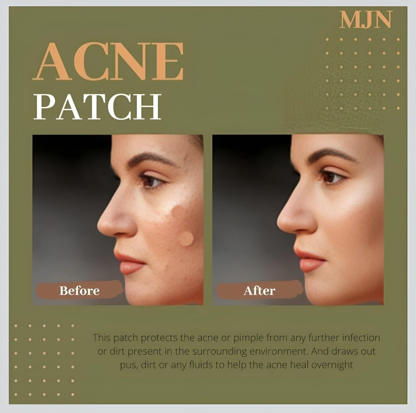 Acne Clearing Pimple Patches (Pack of 2) 144 Patches